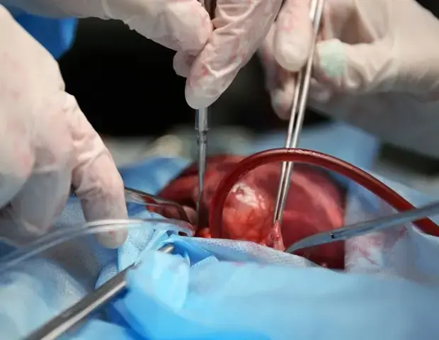 Intravenous Iron Reduces Blood Transfusion Needs in Heart Surgery Patients