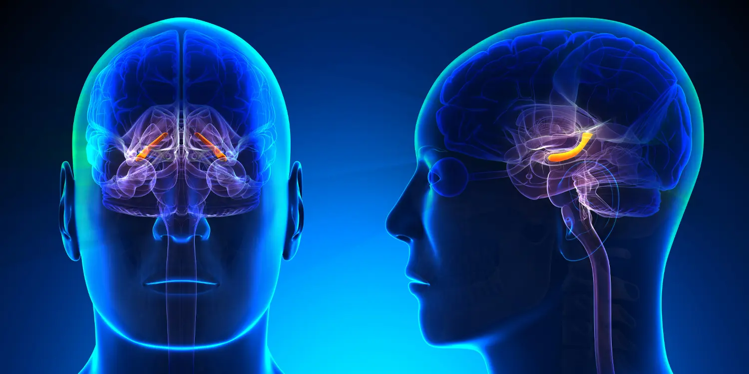 Depression Linked to Reduced Volume in Specific Hippocampal Region